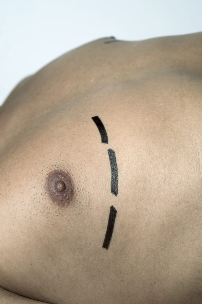 closeup of the chest of a young caucasian man who is about to have a plastic surgery or a liposuction with surgery lines marked around his breast