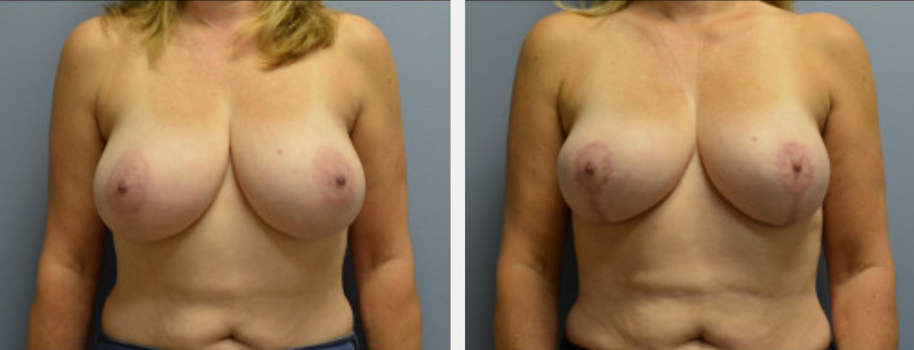 before & after image of breast reduction performed by dr. jessica belz