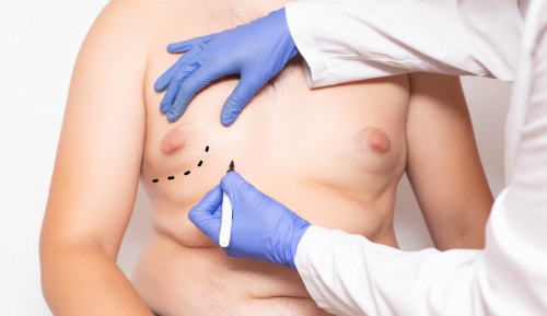 surgeon preparation before surgery to reduce breasts in men gynecomastia