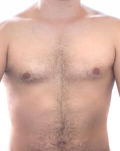 Male Breast Reduction Surgery San Antonio TX